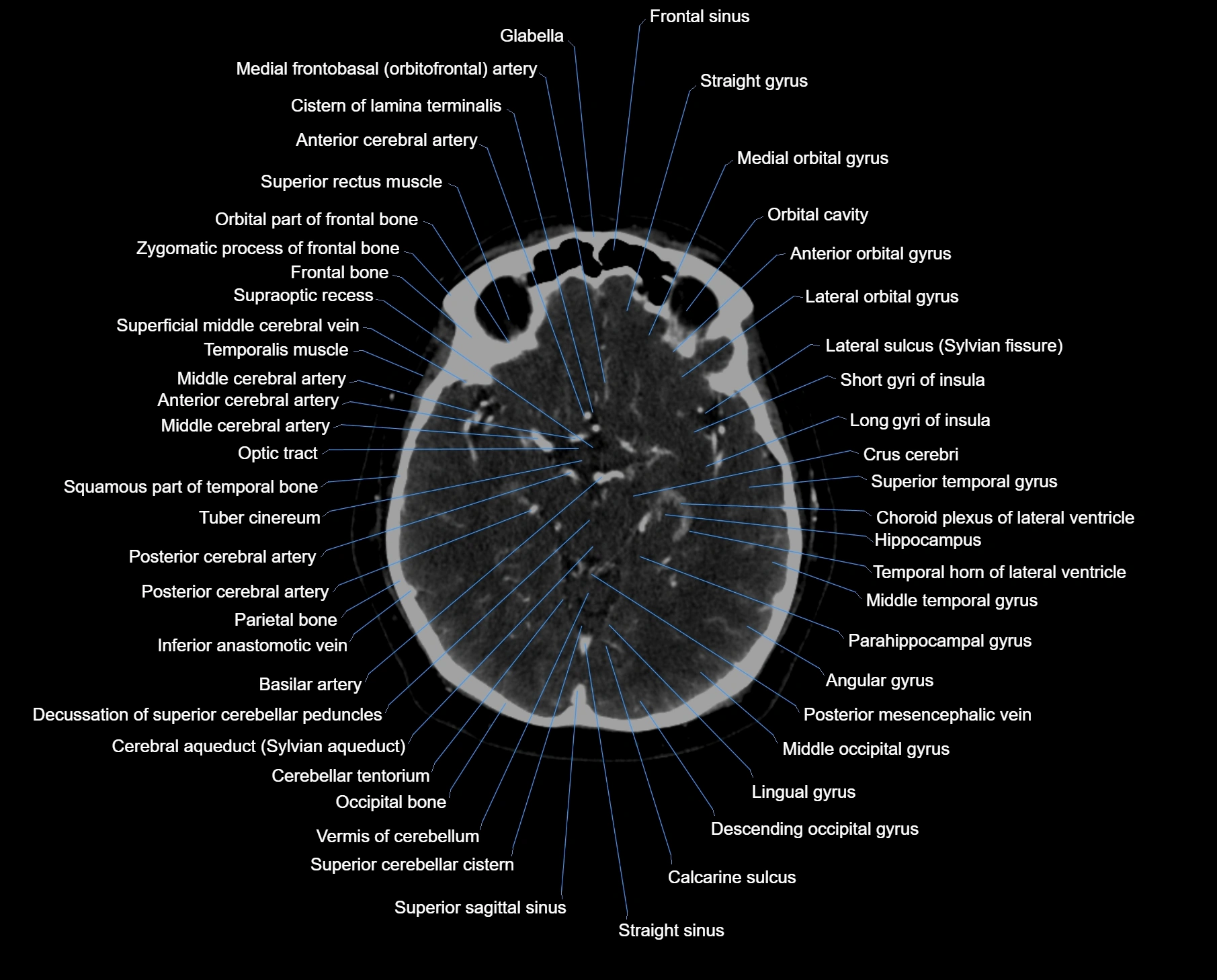CT scan brain axial labelled cross sectional anatomy image-img-000029.webp